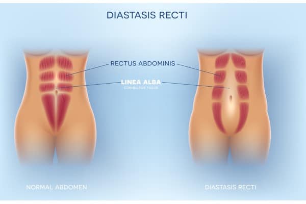 What Non-Surgical Options Are Available for Diastasis Recti Cambridgeshire?