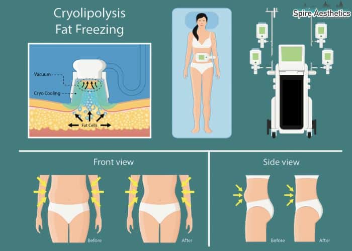 Image of diet and fat freezing combined for best results for Spire Aesthetics Cambridgeshire
