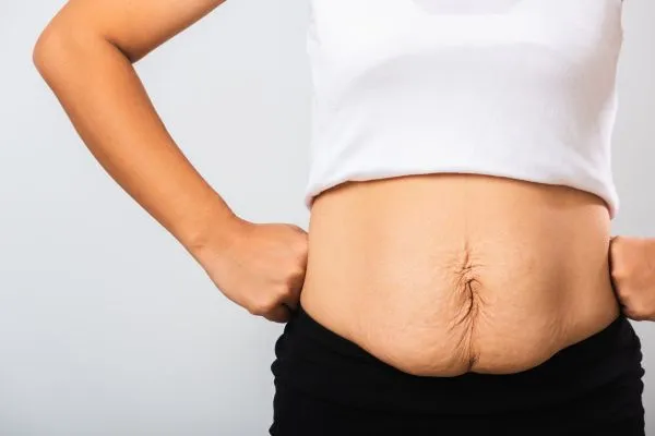 Image of a woman's stomach after weight loss with sagging skin following a gastric band Cambridgeshire