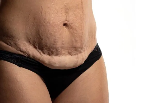 Image of womans stomach after weight loss injections Cambridgeshire showing saggy skin