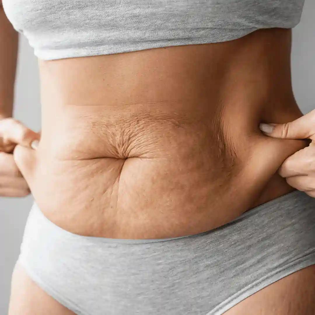 Is It Normal to Have Loose Skin After Pregnancy Cambridgeshire?