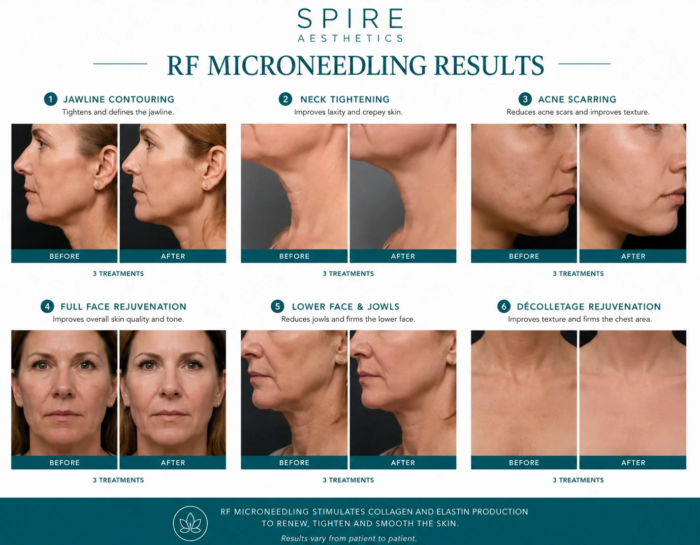 RF Microneedling Skin tightening Cambridgeshire results
