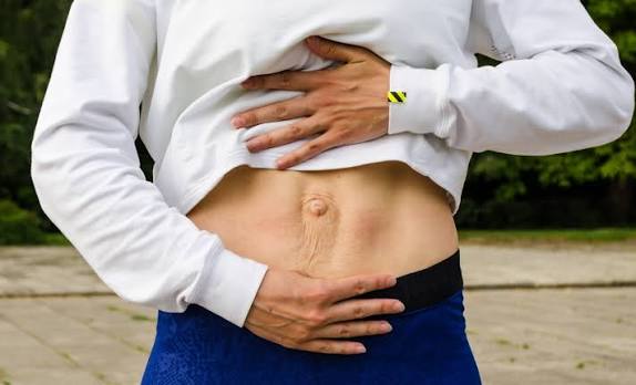 When Could Diastasis Recti Be the Missing Piece of the Puzzle Cambridgeshire?