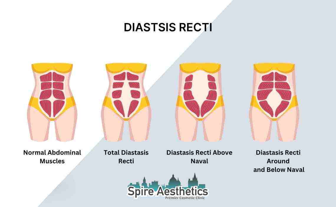 Is Non-Surgical Diastasis Recti Treatment Right for You? Common Concerns Answered Cambridgeshire